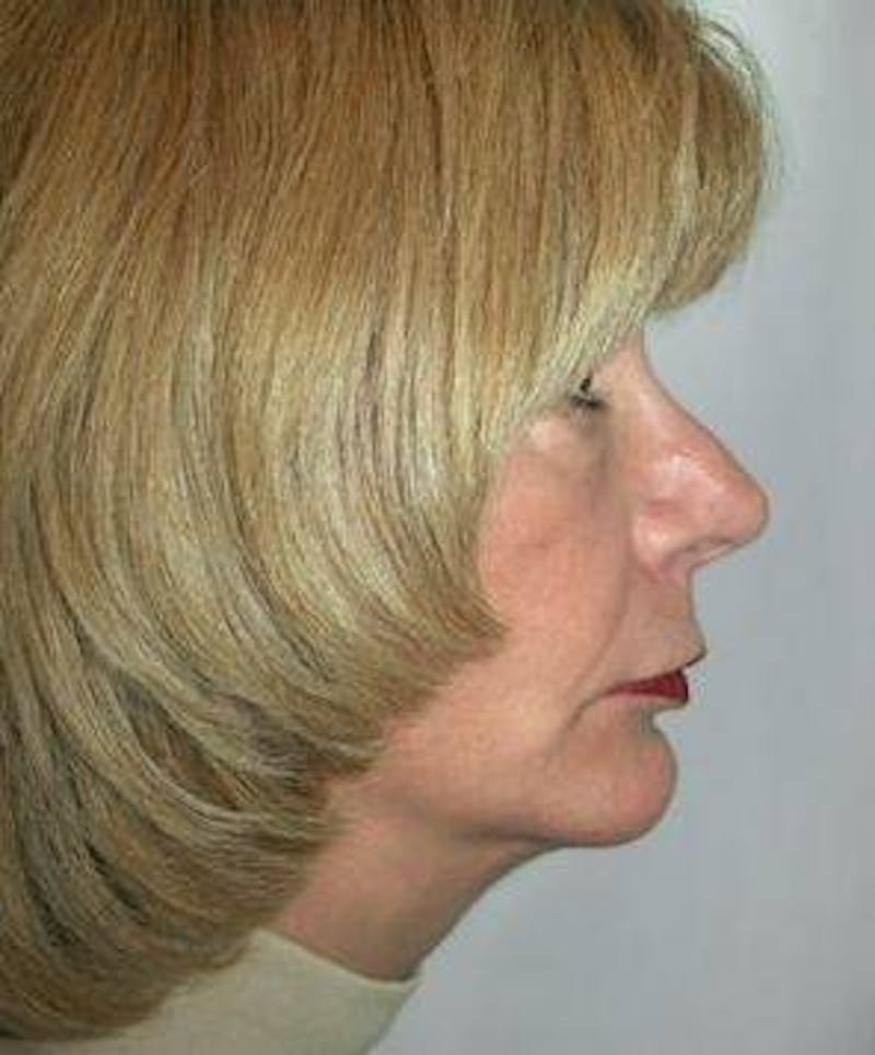 Facial Implants Before & After Gallery - Patient 279456 - Image 2 - Scott Chapin, MD