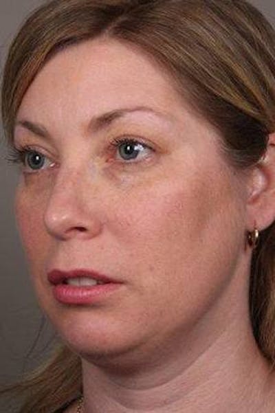 Facial Implants Before & After Gallery - Patient 656690 - Image 1 - Scott Chapin, MD