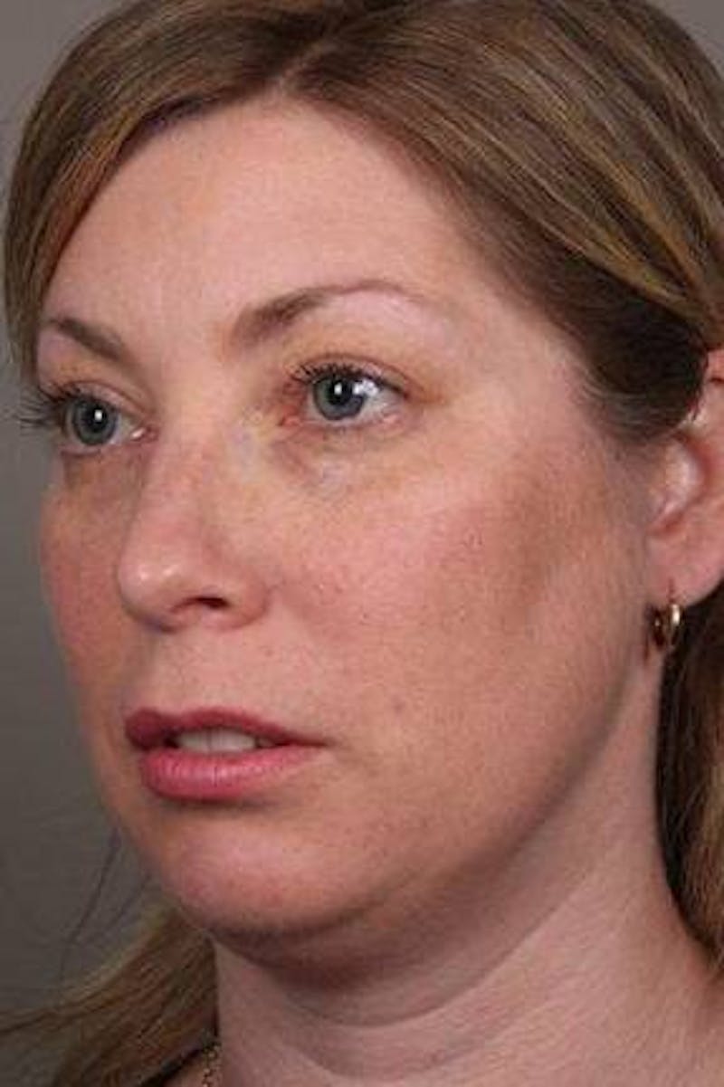 Facial Implants Before & After Gallery - Patient 656690 - Image 1 - Scott Chapin, MD