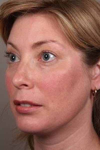 Facial Implants Before & After Gallery - Patient 656690 - Image 2 - Scott Chapin, MD