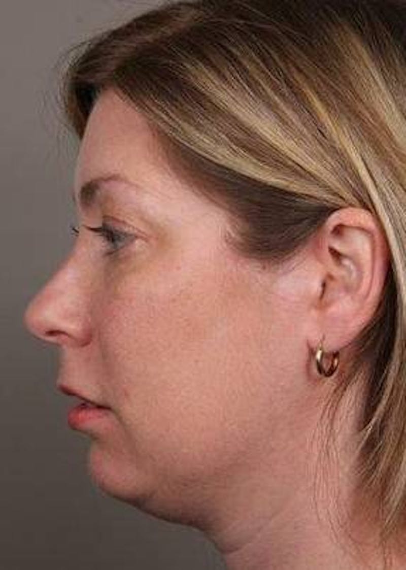 Facial Implants Before & After Gallery - Patient 656690 - Image 3 - Scott Chapin, MD
