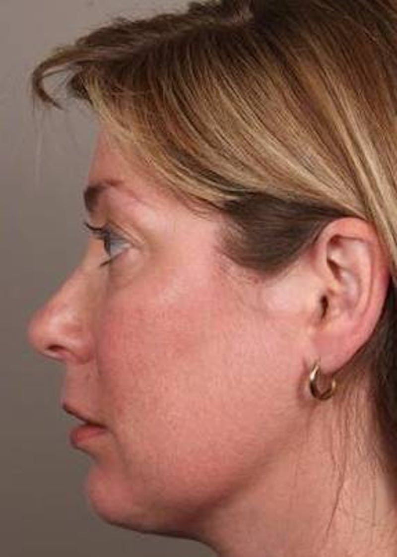 Facial Implants Before & After Gallery - Patient 656690 - Image 4 - Scott Chapin, MD