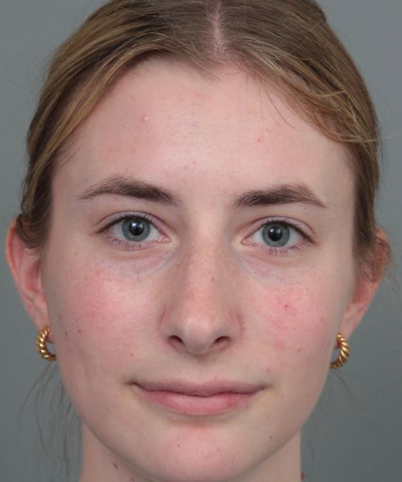 Rhinoplasty Before & After Gallery - Patient 236502 - Image 1 - Scott Chapin, MD