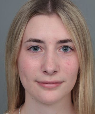 Rhinoplasty Before & After Gallery - Patient 236502 - Image 2 - Scott Chapin, MD