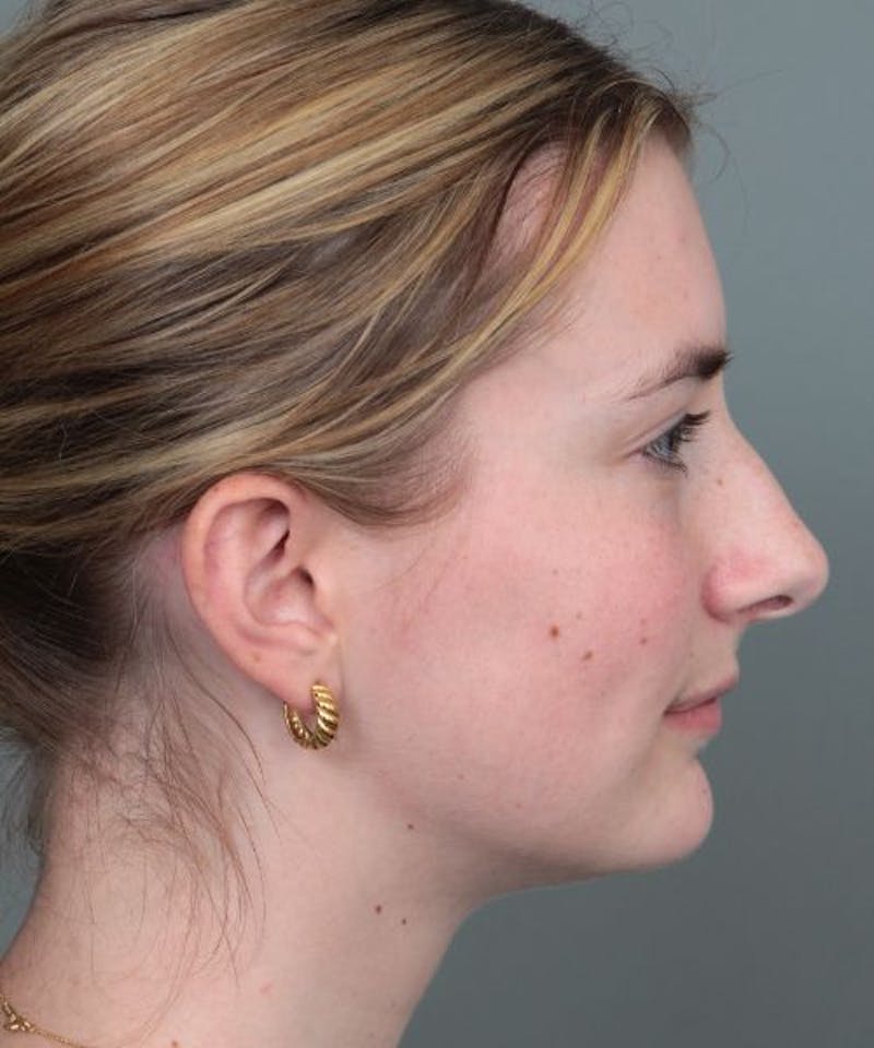 Rhinoplasty Before & After Gallery - Patient 236502 - Image 5 - Scott Chapin, MD