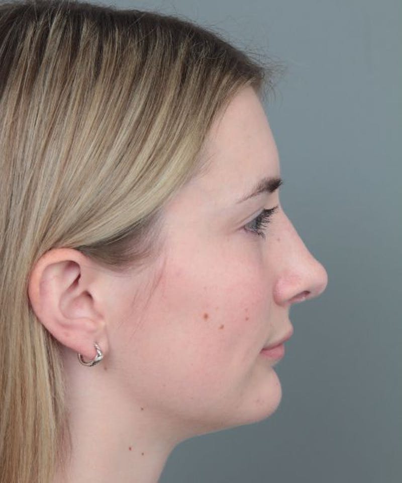 Rhinoplasty Before & After Gallery - Patient 236502 - Image 6 - Scott Chapin, MD
