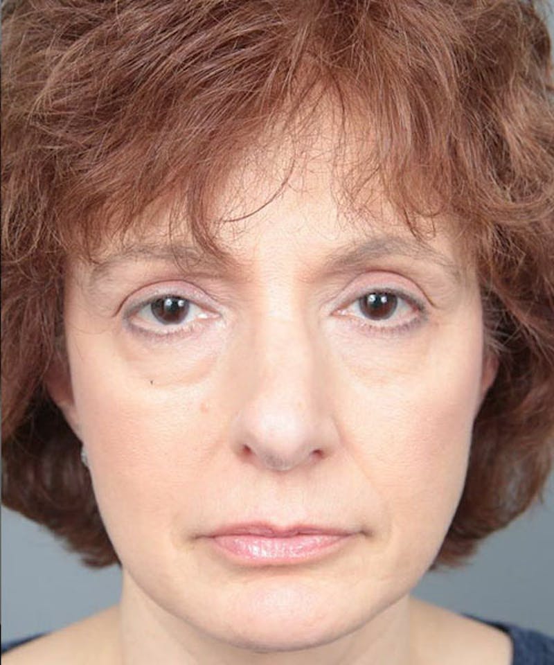 Rhinoplasty Before & After Gallery - Patient 286745 - Image 1 - Scott Chapin, MD