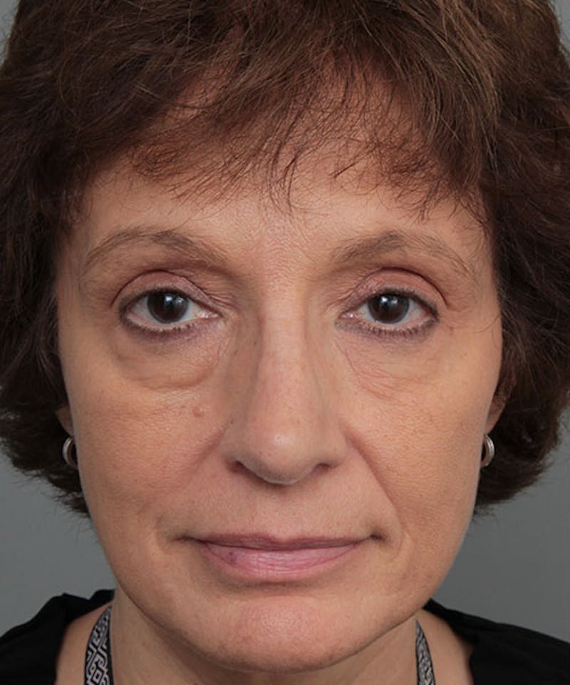 Rhinoplasty Before & After Gallery - Patient 286745 - Image 2 - Scott Chapin, MD