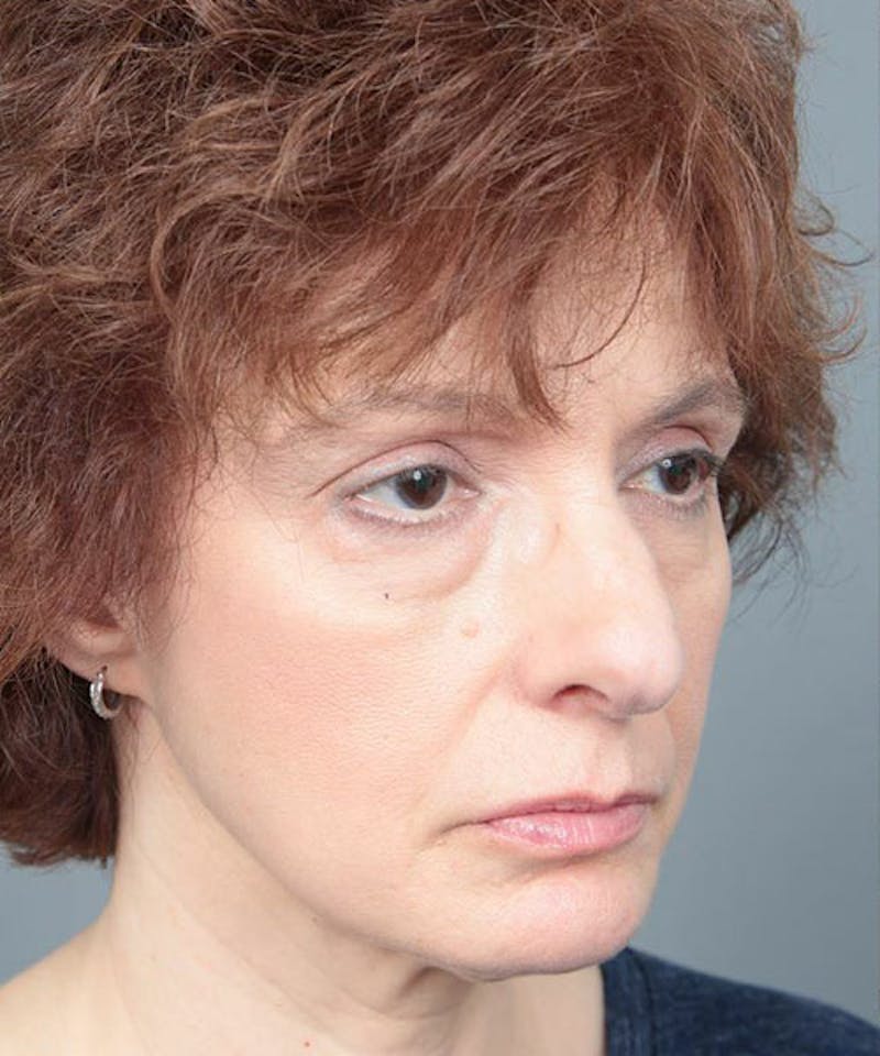 Rhinoplasty Before & After Gallery - Patient 286745 - Image 3 - Scott Chapin, MD