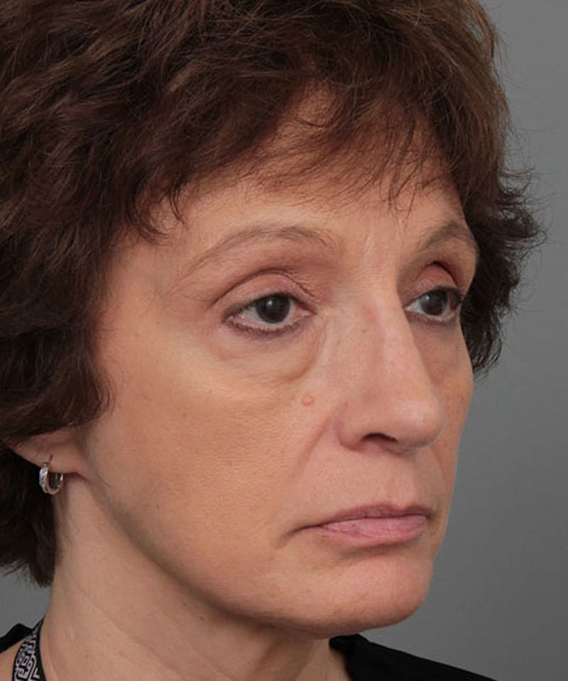 Rhinoplasty Before & After Gallery - Patient 286745 - Image 4 - Scott Chapin, MD