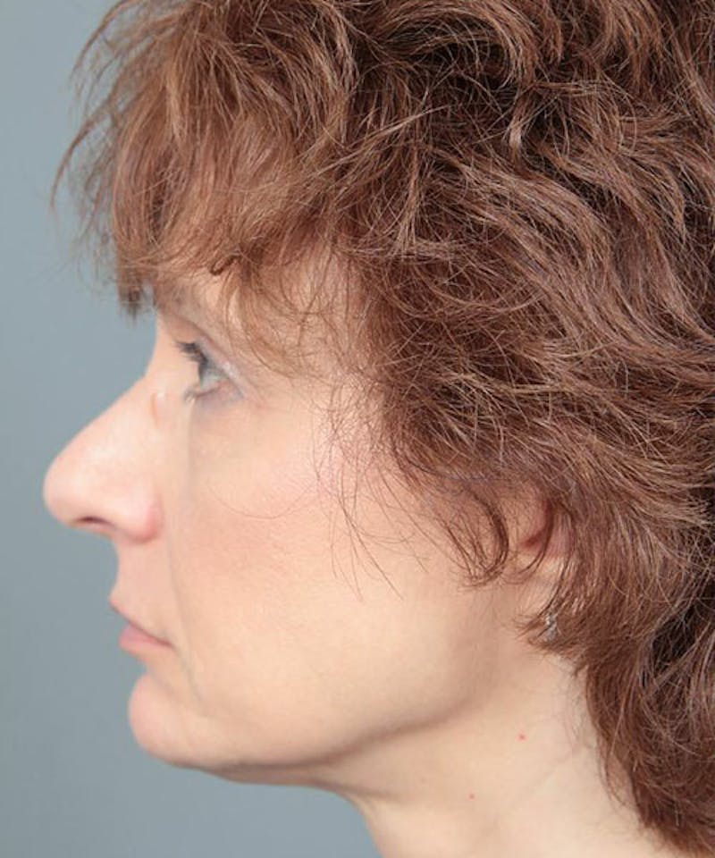 Rhinoplasty Before & After Gallery - Patient 286745 - Image 5 - Scott Chapin, MD