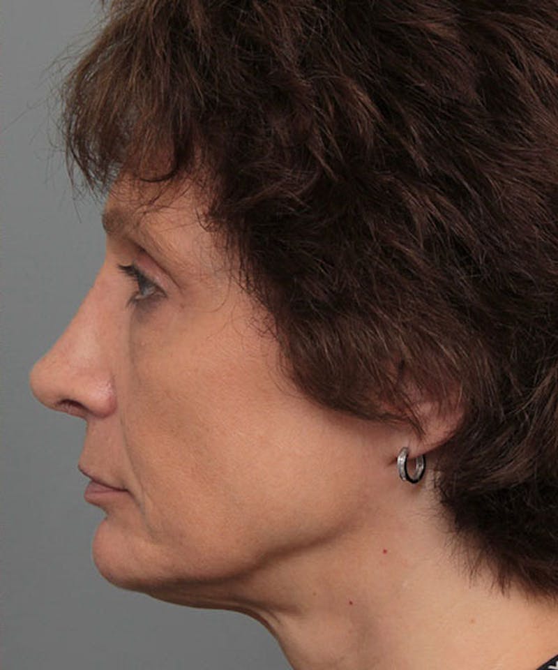 Rhinoplasty Before & After Gallery - Patient 286745 - Image 6 - Scott Chapin, MD