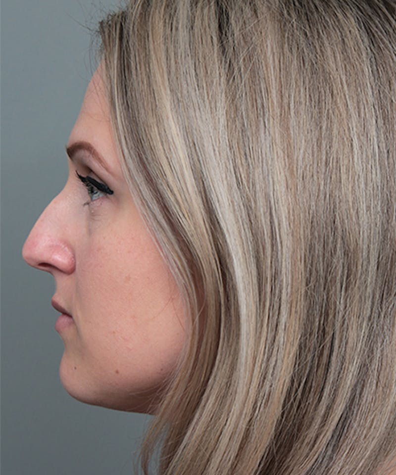 Rhinoplasty Before & After Gallery - Patient 362024 - Image 1 - Scott Chapin, MD
