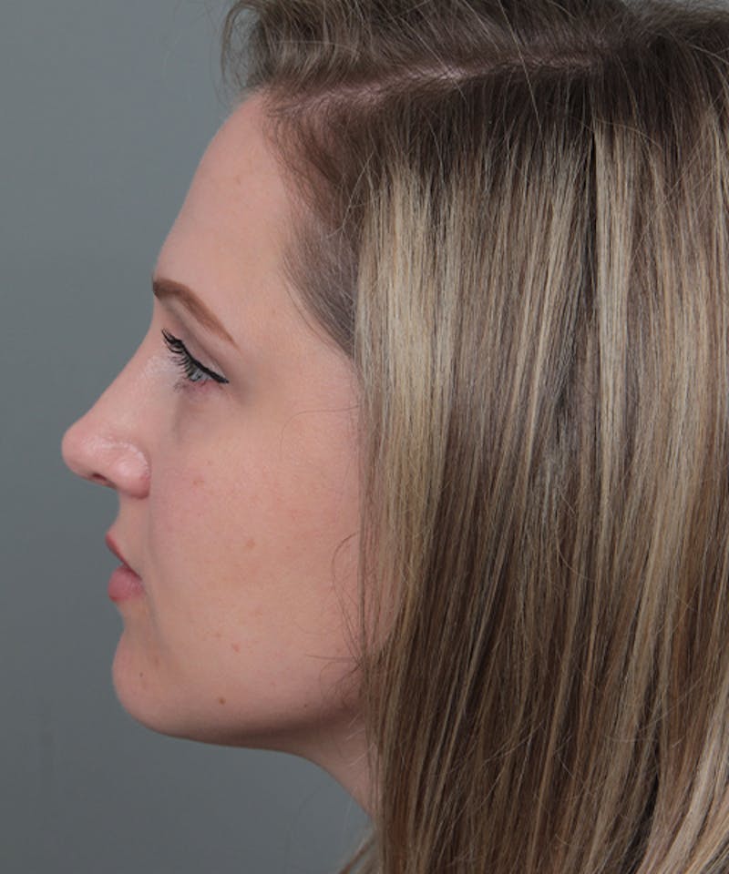 Rhinoplasty Before & After Gallery - Patient 362024 - Image 2 - Scott Chapin, MD