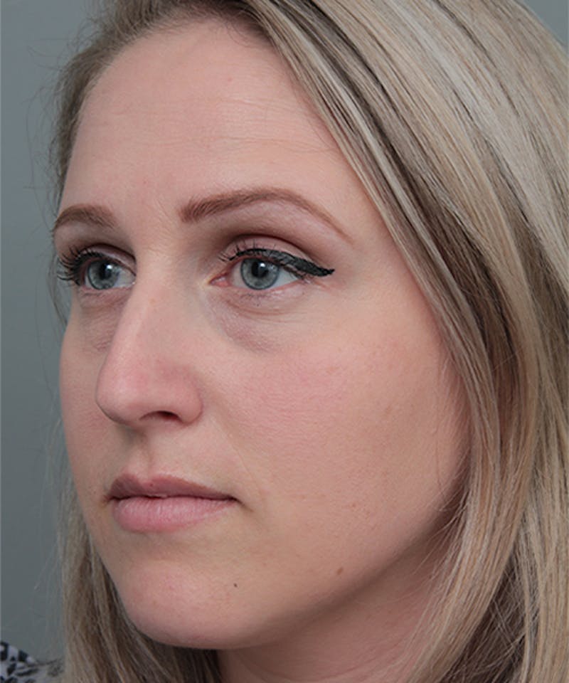 Rhinoplasty Before & After Gallery - Patient 362024 - Image 3 - Scott Chapin, MD