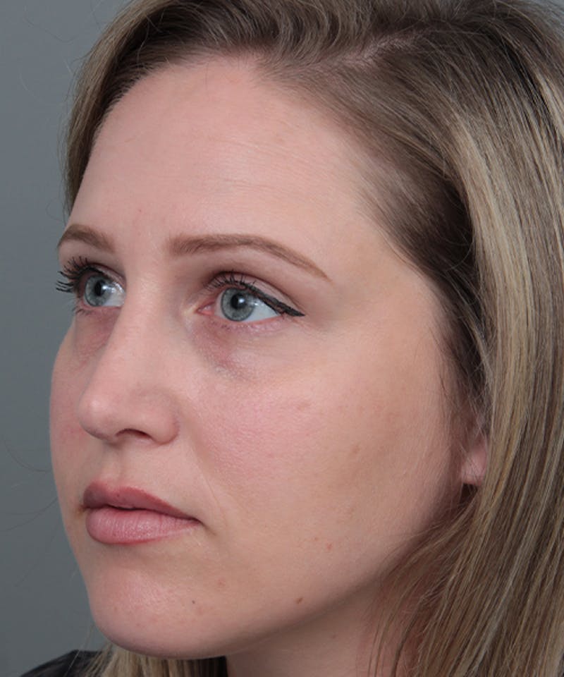 Rhinoplasty Before & After Gallery - Patient 362024 - Image 4 - Scott Chapin, MD