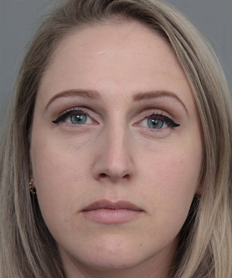 Rhinoplasty Before & After Gallery - Patient 362024 - Image 5 - Scott Chapin, MD