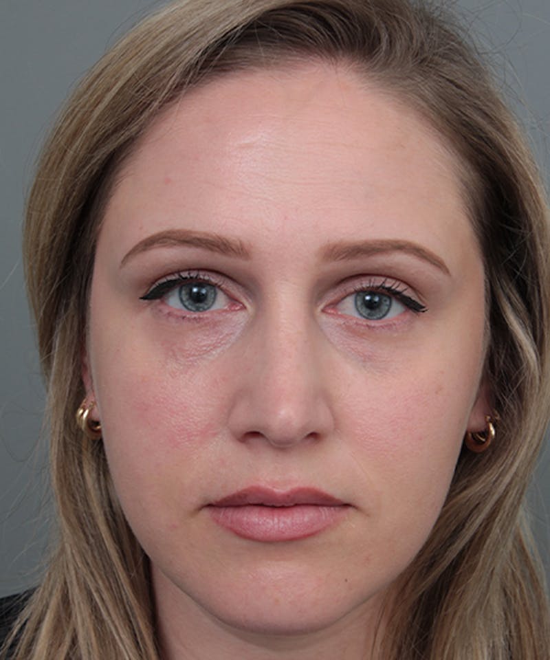 Rhinoplasty Before & After Gallery - Patient 362024 - Image 6 - Scott Chapin, MD