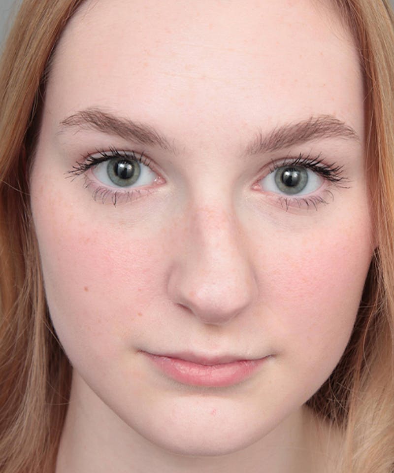 Rhinoplasty Before & After Gallery - Patient 250279 - Image 1 - Scott Chapin, MD