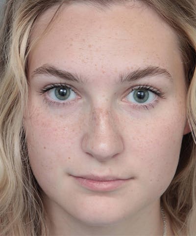Rhinoplasty Before & After Gallery - Patient 250279 - Image 2 - Scott Chapin, MD