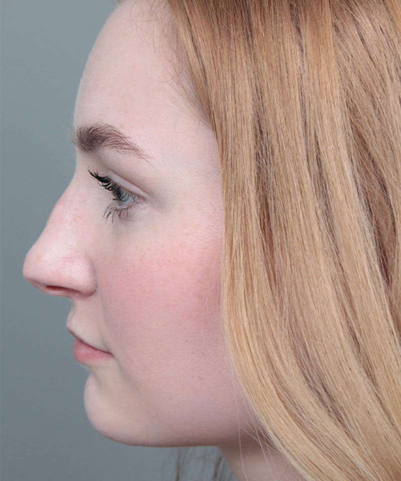 Rhinoplasty Before & After Gallery - Patient 250279 - Image 3 - Scott Chapin, MD