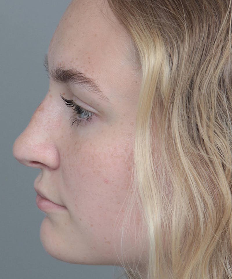Rhinoplasty Before & After Gallery - Patient 250279 - Image 4 - Scott Chapin, MD