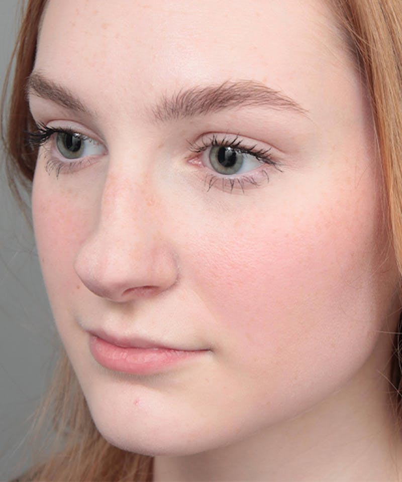 Rhinoplasty Before & After Gallery - Patient 250279 - Image 5 - Scott Chapin, MD