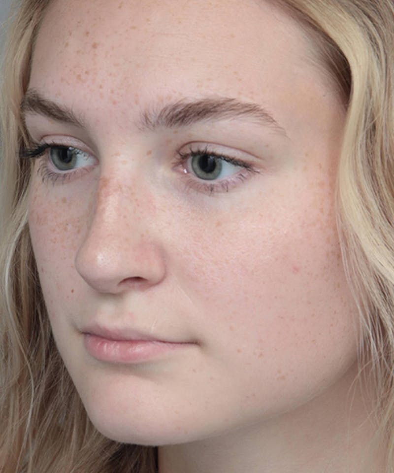 Rhinoplasty Before & After Gallery - Patient 250279 - Image 6 - Scott Chapin, MD