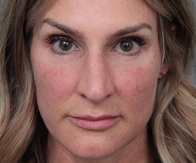 Rhinoplasty Before & After Gallery - Patient 316638 - Image 1 - Scott Chapin, MD