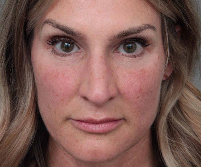 Rhinoplasty Before & After Gallery - Patient 316638 - Image 1 - Scott Chapin, MD