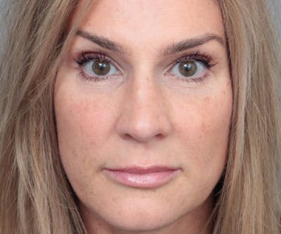 Rhinoplasty Before & After Gallery - Patient 316638 - Image 2 - Scott Chapin, MD