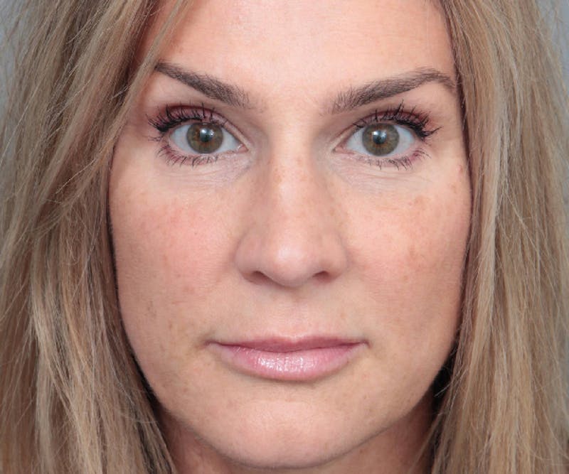 Rhinoplasty Before & After Gallery - Patient 316638 - Image 2 - Scott Chapin, MD