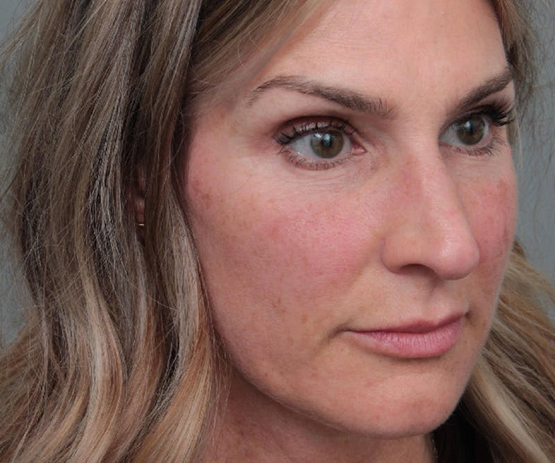 Rhinoplasty Before & After Gallery - Patient 316638 - Image 3 - Scott Chapin, MD