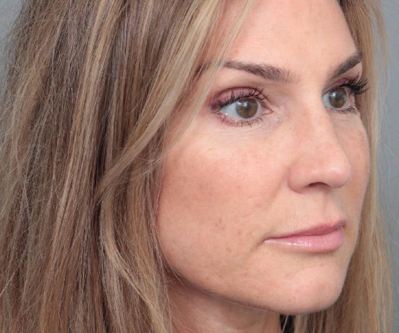 Rhinoplasty Before & After Gallery - Patient 316638 - Image 4 - Scott Chapin, MD