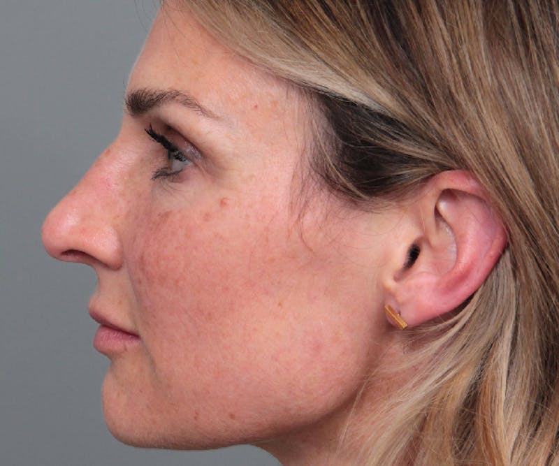 Rhinoplasty Before & After Gallery - Patient 316638 - Image 5 - Scott Chapin, MD