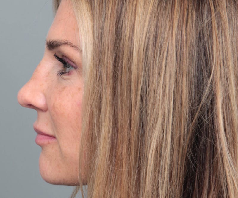 Rhinoplasty Before & After Gallery - Patient 316638 - Image 6 - Scott Chapin, MD