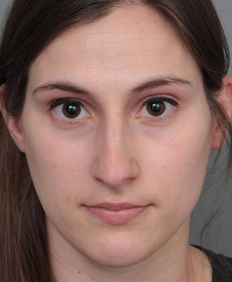 Rhinoplasty Before & After Gallery - Patient 224823 - Image 1 - Scott Chapin, MD