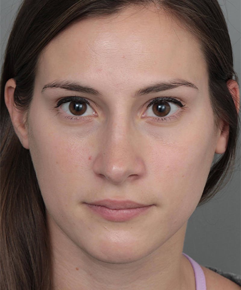 Rhinoplasty Before & After Gallery - Patient 224823 - Image 2 - Scott Chapin, MD