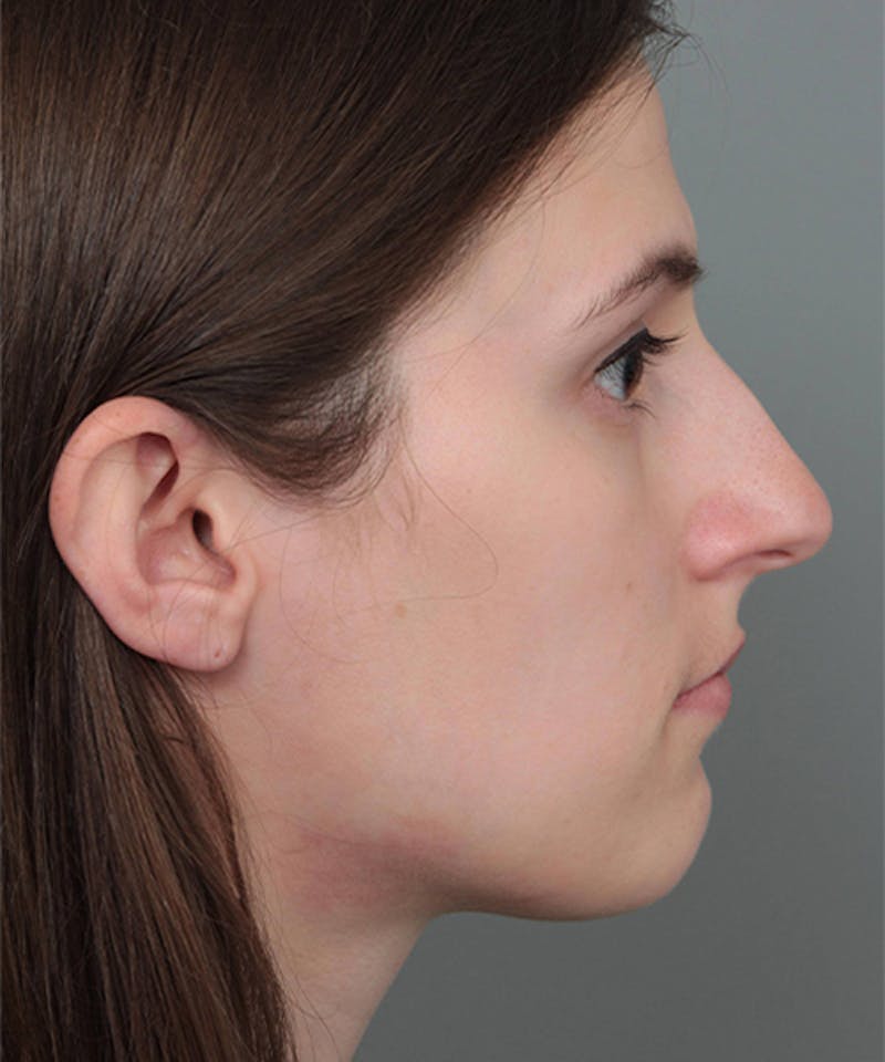 Rhinoplasty Before & After Gallery - Patient 224823 - Image 3 - Scott Chapin, MD