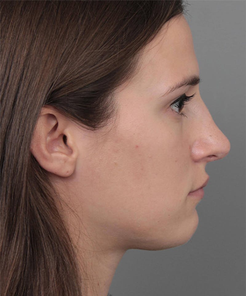 Rhinoplasty Before & After Gallery - Patient 224823 - Image 4 - Scott Chapin, MD