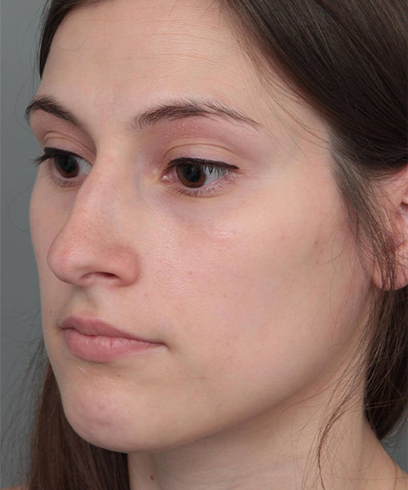 Rhinoplasty Before & After Gallery - Patient 224823 - Image 5 - Scott Chapin, MD