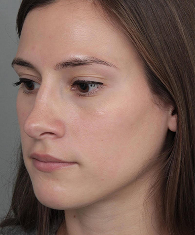 Rhinoplasty Before & After Gallery - Patient 224823 - Image 6 - Scott Chapin, MD