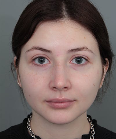 Rhinoplasty Before & After Gallery - Patient 246315 - Image 1 - Scott Chapin, MD