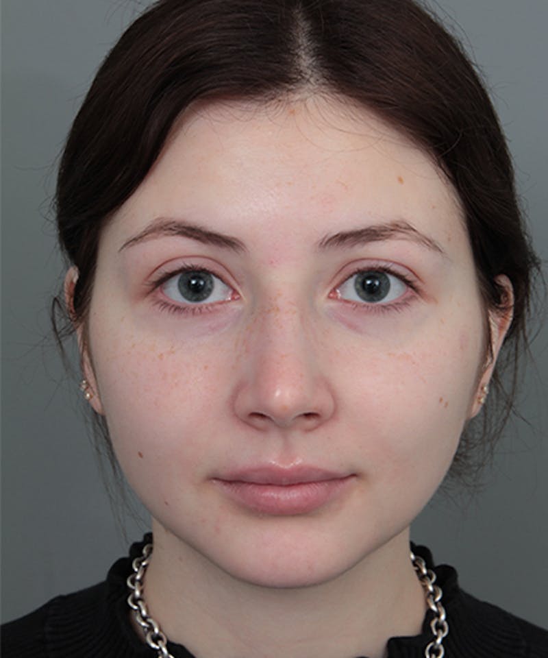 Rhinoplasty Before & After Gallery - Patient 246315 - Image 1 - Scott Chapin, MD