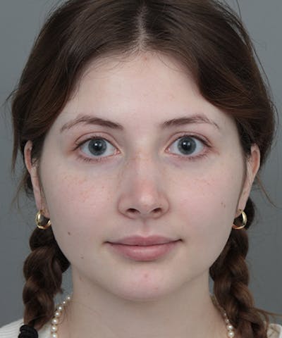 Rhinoplasty Before & After Gallery - Patient 246315 - Image 2 - Scott Chapin, MD