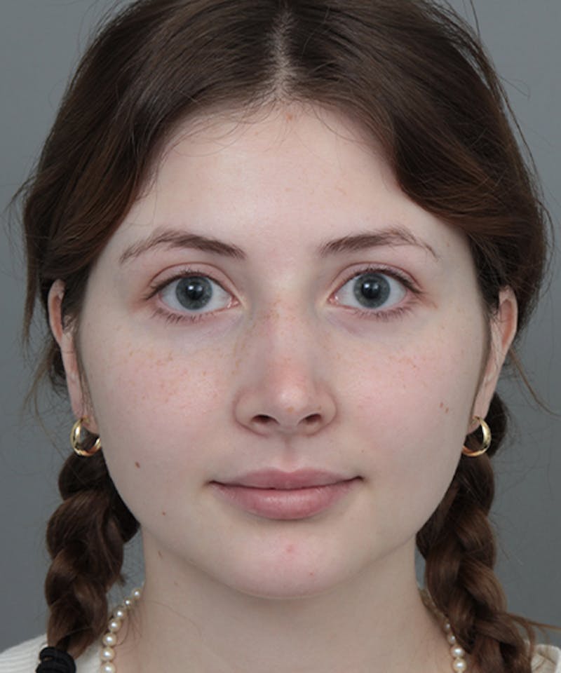 Rhinoplasty Before & After Gallery - Patient 246315 - Image 2 - Scott Chapin, MD