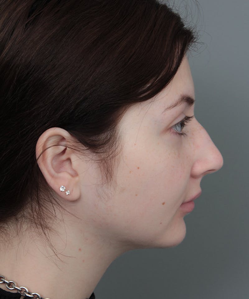 Rhinoplasty Before & After Gallery - Patient 246315 - Image 3 - Scott Chapin, MD