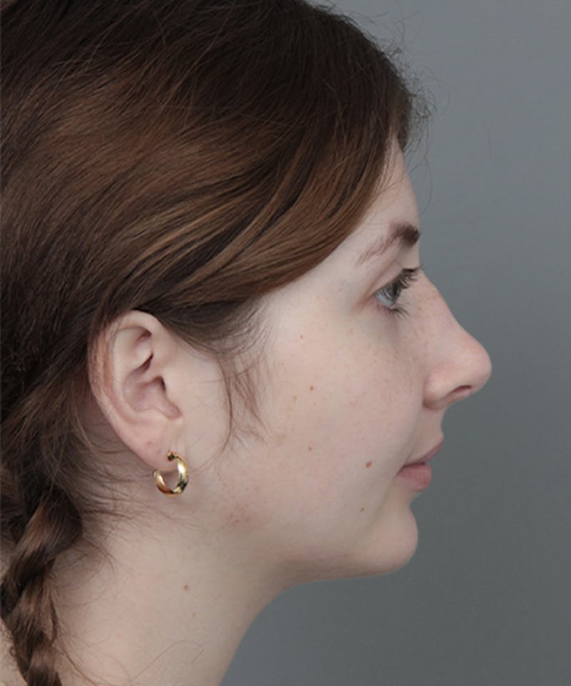 Rhinoplasty Before & After Gallery - Patient 246315 - Image 4 - Scott Chapin, MD