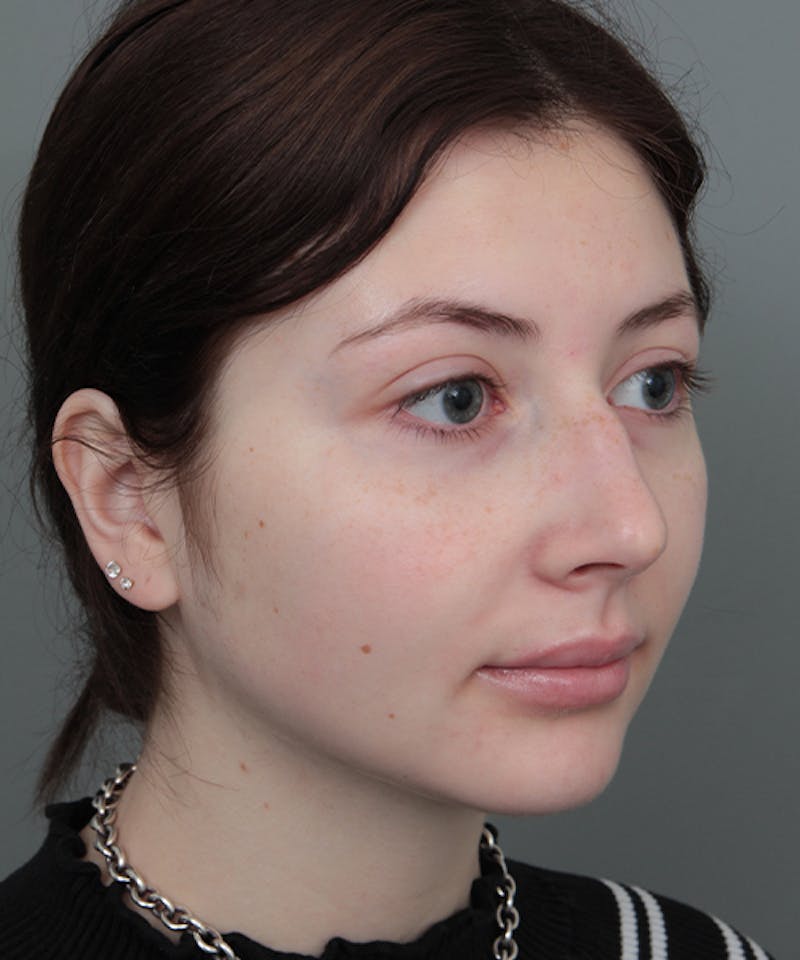 Rhinoplasty Before & After Gallery - Patient 246315 - Image 5 - Scott Chapin, MD