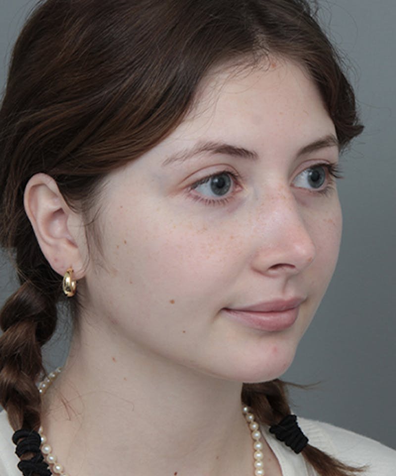 Rhinoplasty Before & After Gallery - Patient 246315 - Image 6 - Scott Chapin, MD